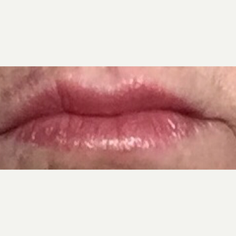 55-64 year old woman treated with Juvederm and Restylane after 3092368