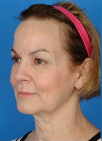 57 year old female who wanted a more defined jawline and tighter neck. before 1173970