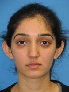 Otoplasty Ear Surgery - Female before 1094355