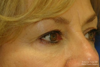 55 year-old woman underwent Restylane injections to blend away eyebags and give a virtual cheeklift. after 1481460