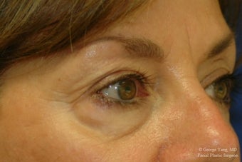 55 year-old woman underwent Restylane injections to blend away eyebags and give a virtual cheeklift. before 1481460