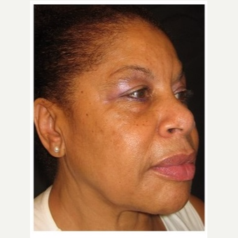 55-64 year old woman treated with Non Surgical Face Lift after 3181102