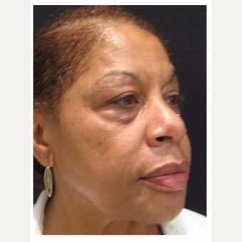 55-64 year old woman treated with Non Surgical Face Lift before 3181102