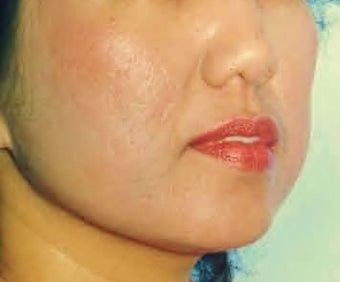 Acne Scars Dermabrasion minimal, only after 1281256