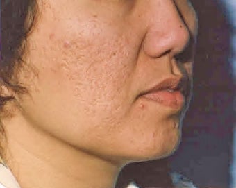Acne Scars Dermabrasion minimal, only before 1281256