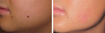 Mole Removal photos before 951871