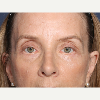 55-64 year old woman treated with Eyelid Surgery (view 1 of 2) after 3226180