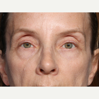 55-64 year old woman treated with Eyelid Surgery (view 1 of 2) before 3226180