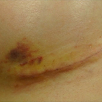 Breast augmentation scar before and after treatment with embrace® before 2864548