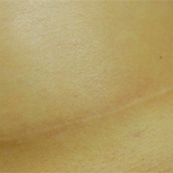 Breast augmentation scar before and after treatment with embrace® after 2864548