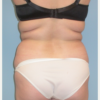 35-44 year old woman treated with Liposuction before 3053571