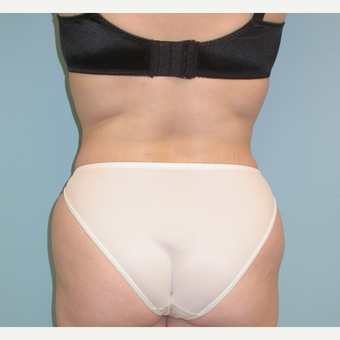 35-44 year old woman treated with Liposuction after 3053571