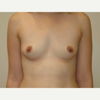 25-34 year old woman with Breast Augmentation - 450cc Gel Implants before 1688355