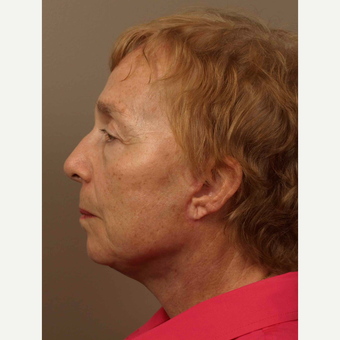 55-64 year old woman treated with Facelift after 3031623