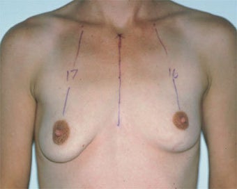 Breast Asymmetry Correction before 281316