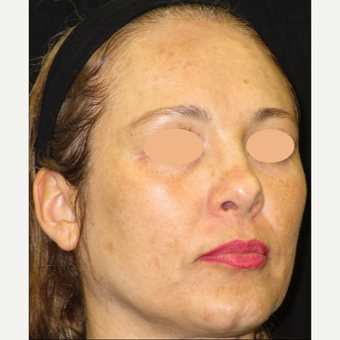 45-54 year old woman treated with Laser Treatment before 3140091