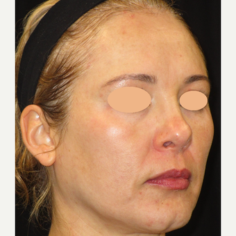 45-54 year old woman treated with Laser Treatment after 3140091
