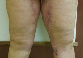 55-64 year old woman treated with Medial Thigh Lift after 2647475