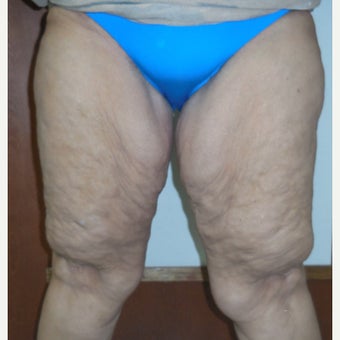 55-64 year old woman treated with Medial Thigh Lift before 2647475