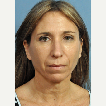 45-54 year old woman treated with Contoura before 3454289