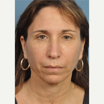 45-54 year old woman treated with Contoura after 3454289