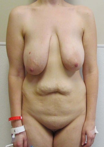 Breast Lift and Tummy Tuck (Abdominoplasty) for this 32 year old female before 1268936