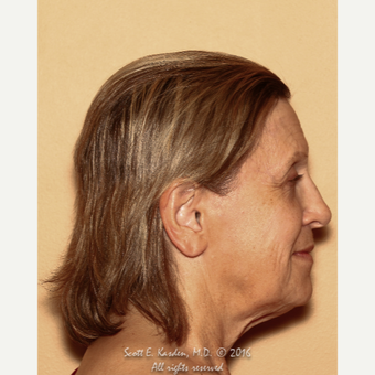 65-74 year old woman treated with SMAS Facelift before 3612172