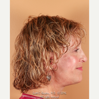 65-74 year old woman treated with SMAS Facelift after 3612172