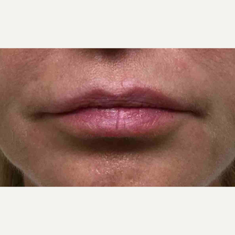 45-54 year old woman treated with Restylane to the lips before 3168458