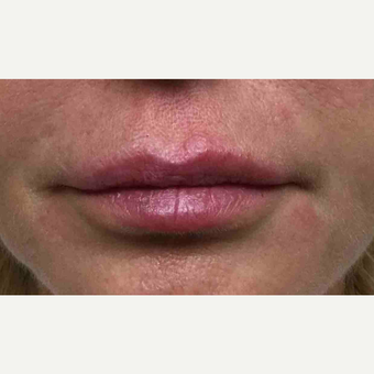 45-54 year old woman treated with Restylane to the lips after 3168458