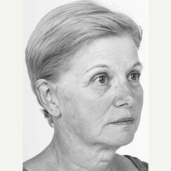 55-64 year old woman treated with Non Surgical Face Lift 1560122