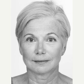 55-64 year old woman treated with Non Surgical Face Lift after 1560122