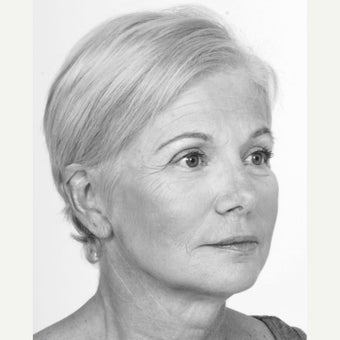 55-64 year old woman treated with Non Surgical Face Lift 1560122