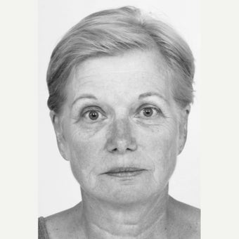 55-64 year old woman treated with Non Surgical Face Lift before 1560122