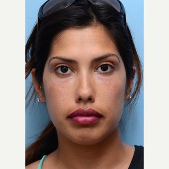 Eye Bags Treatment after 2551119