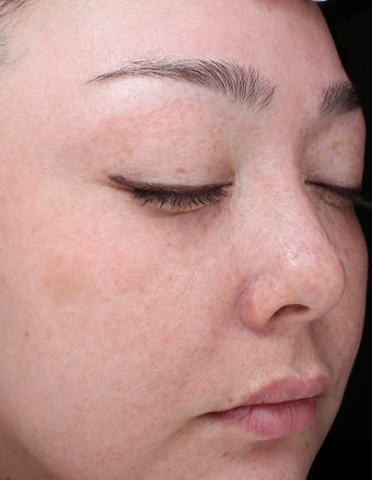 35 year old woman treated with Halo Laser and BBL 3656458