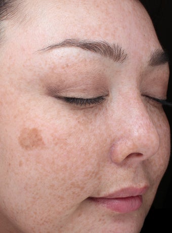 35 year old woman treated with Halo Laser and BBL 3656458
