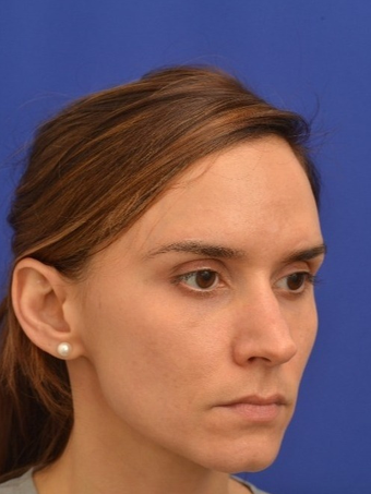 35 year old woman treated with Voluma before 1694981