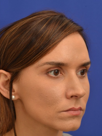 35 year old woman treated with Voluma after 1694981