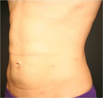 SmartLipo MPX after 686315