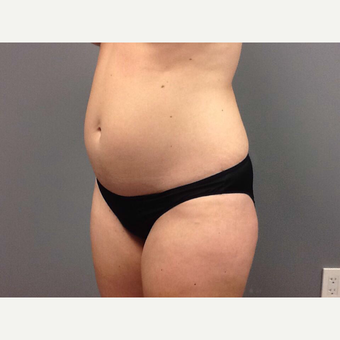 35-44 year old woman treated with Tummy Tuck before 3202373