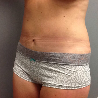 35-44 year old woman treated with Tummy Tuck after 3202373
