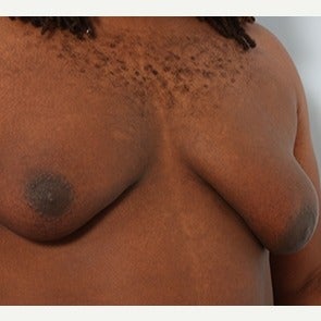 Male Breast Reduction before 1793965