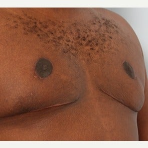 Male Breast Reduction after 1793965