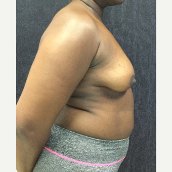 35-44 year old woman treated with Breast Lift with Implants before 3219468