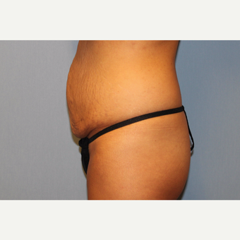 25-34 year old woman treated with Tummy Tuck before 3529337