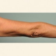 Smartlipo arms 1699993