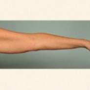 Smartlipo arms before 1699993