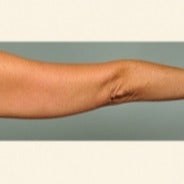 Smartlipo arms 1699993