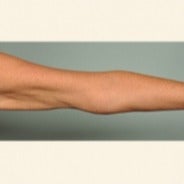 Smartlipo arms after 1699993